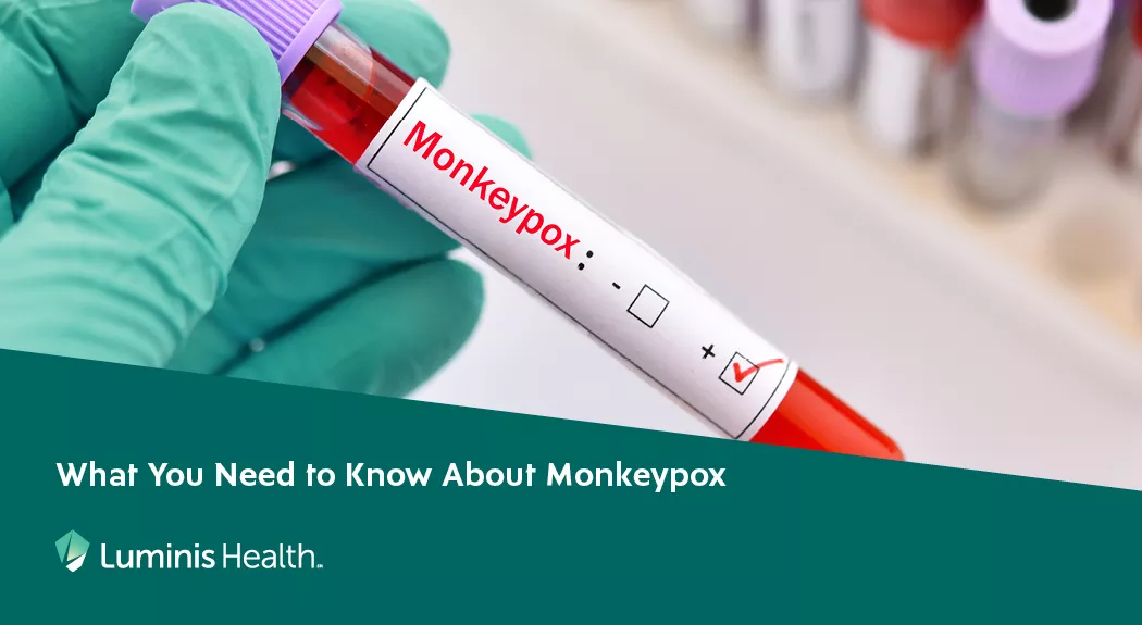 monkeypox