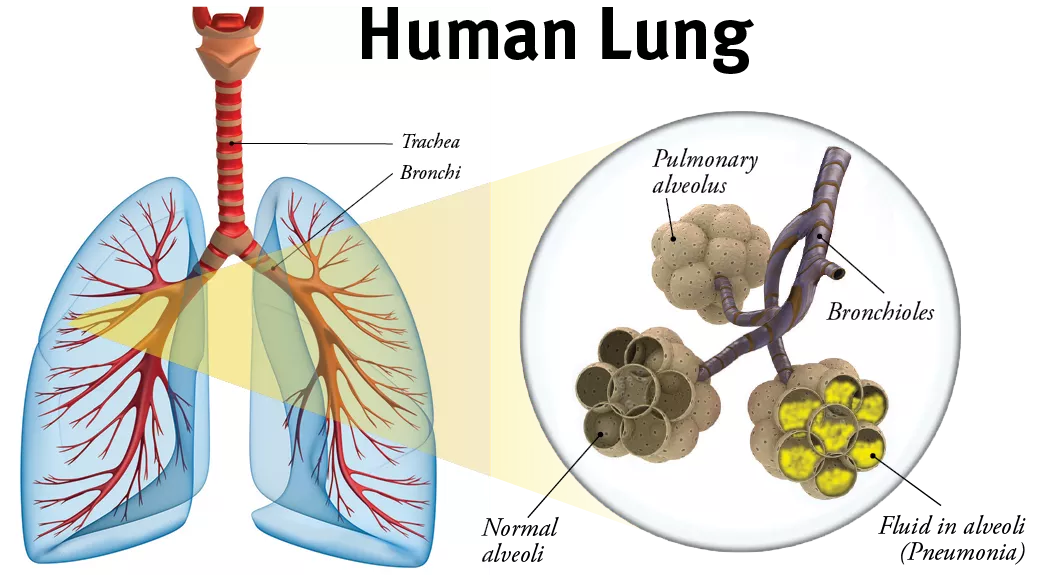 pneumonia 101