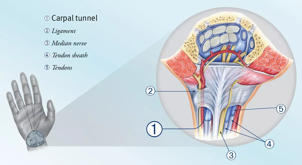 carpal-tunnel